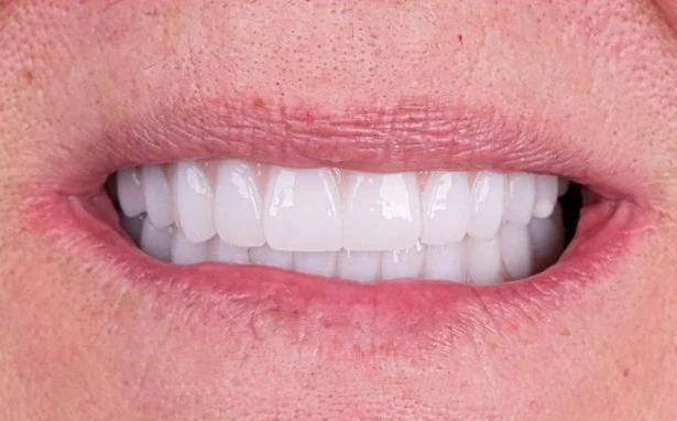 Después: dientes nuevos y blancos en ambos maxilares