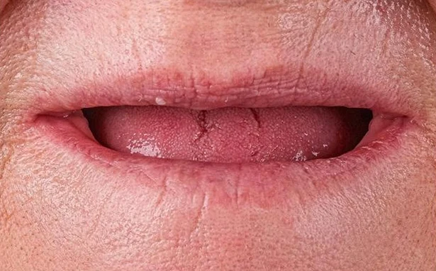Antes: boca sin dientes